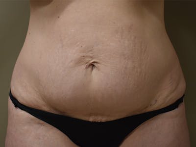 Tummy Tuck by Dr. Mark Sofonio — before