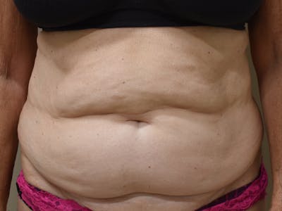 Tummy Tuck by Dr. Mark Sofonio — before