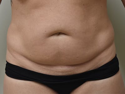 Tummy Tuck by Dr. Mark Sofonio — before