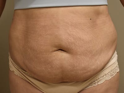 Tummy Tuck by Dr. Mark Sofonio — before