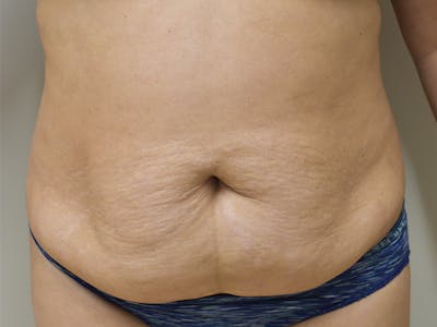 Tummy Tuck by Dr. Mark Sofonio — before