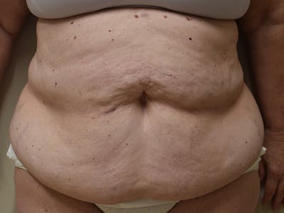 Tummy Tuck by Dr. Mark Sofonio — before
