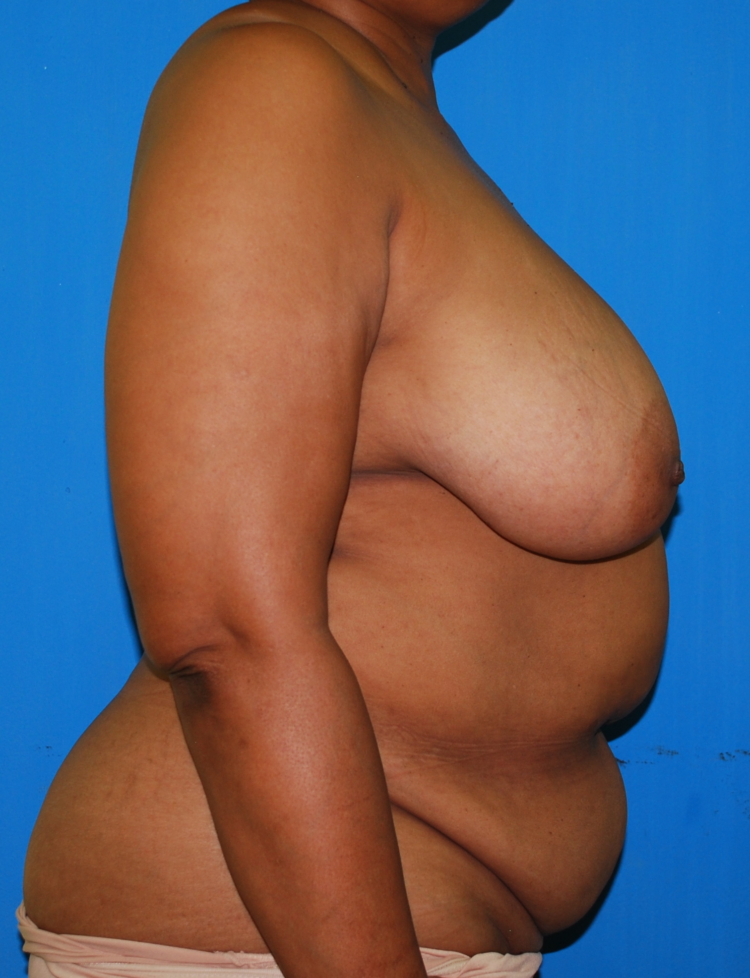 Tissue Reconstruction before and after - after