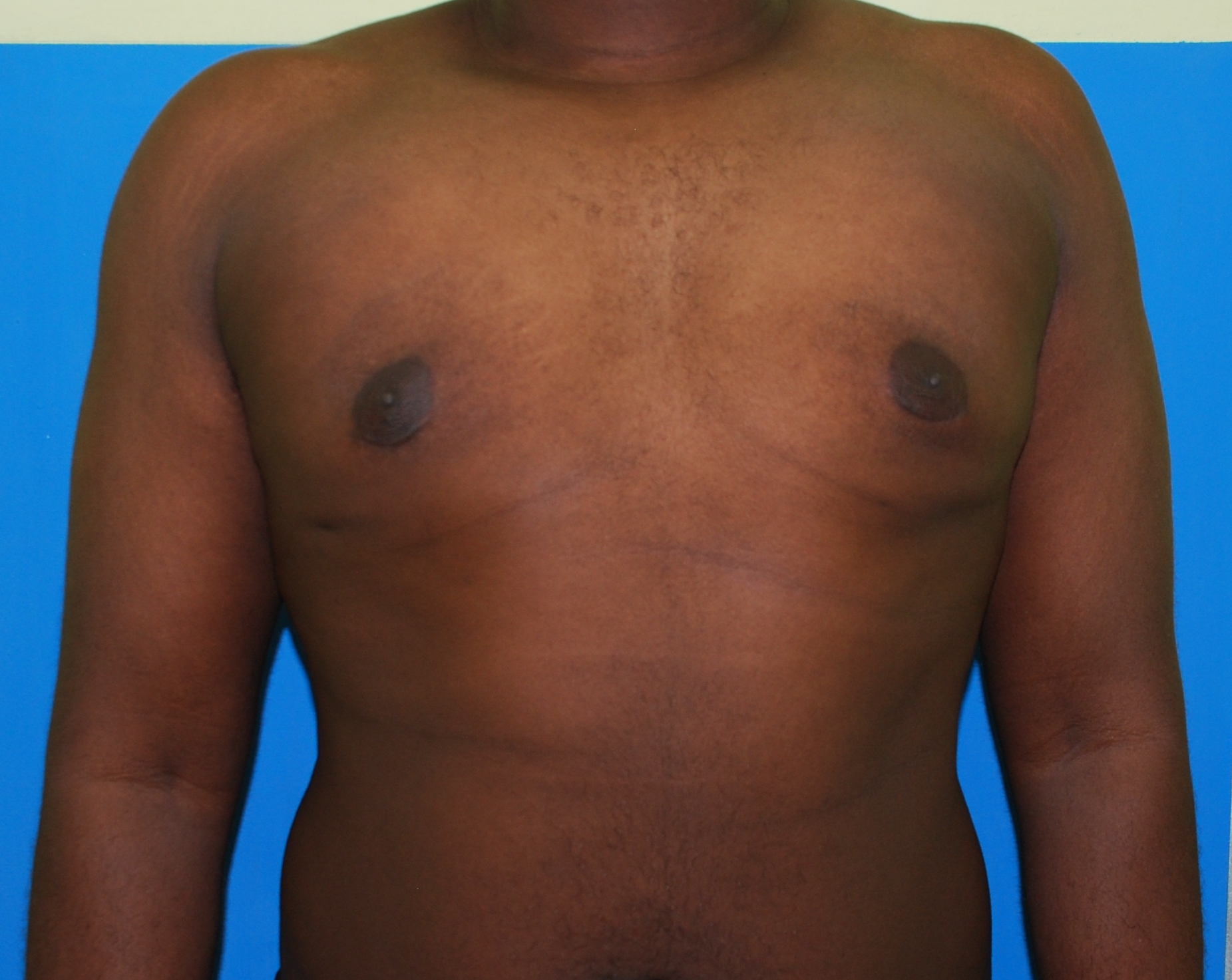 Gynaecomastia before and after - after