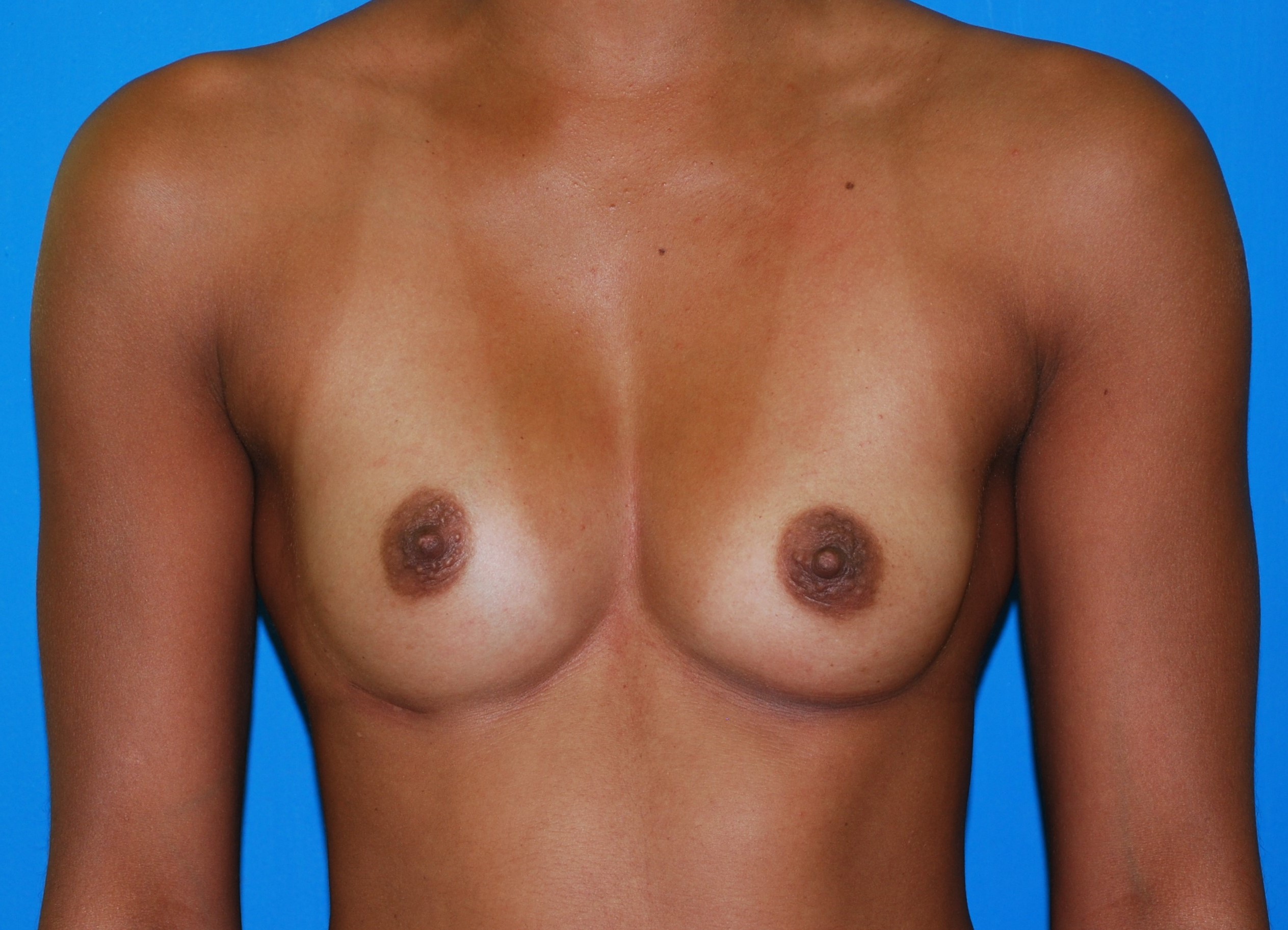 Augmentation before and after - after
