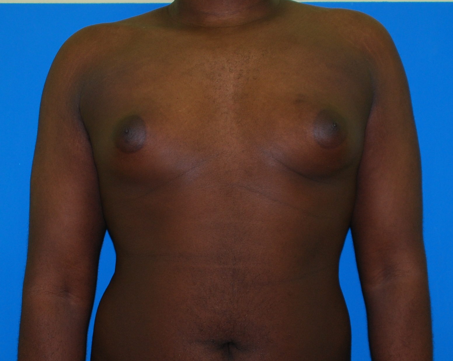 Gynaecomastia before and after - before