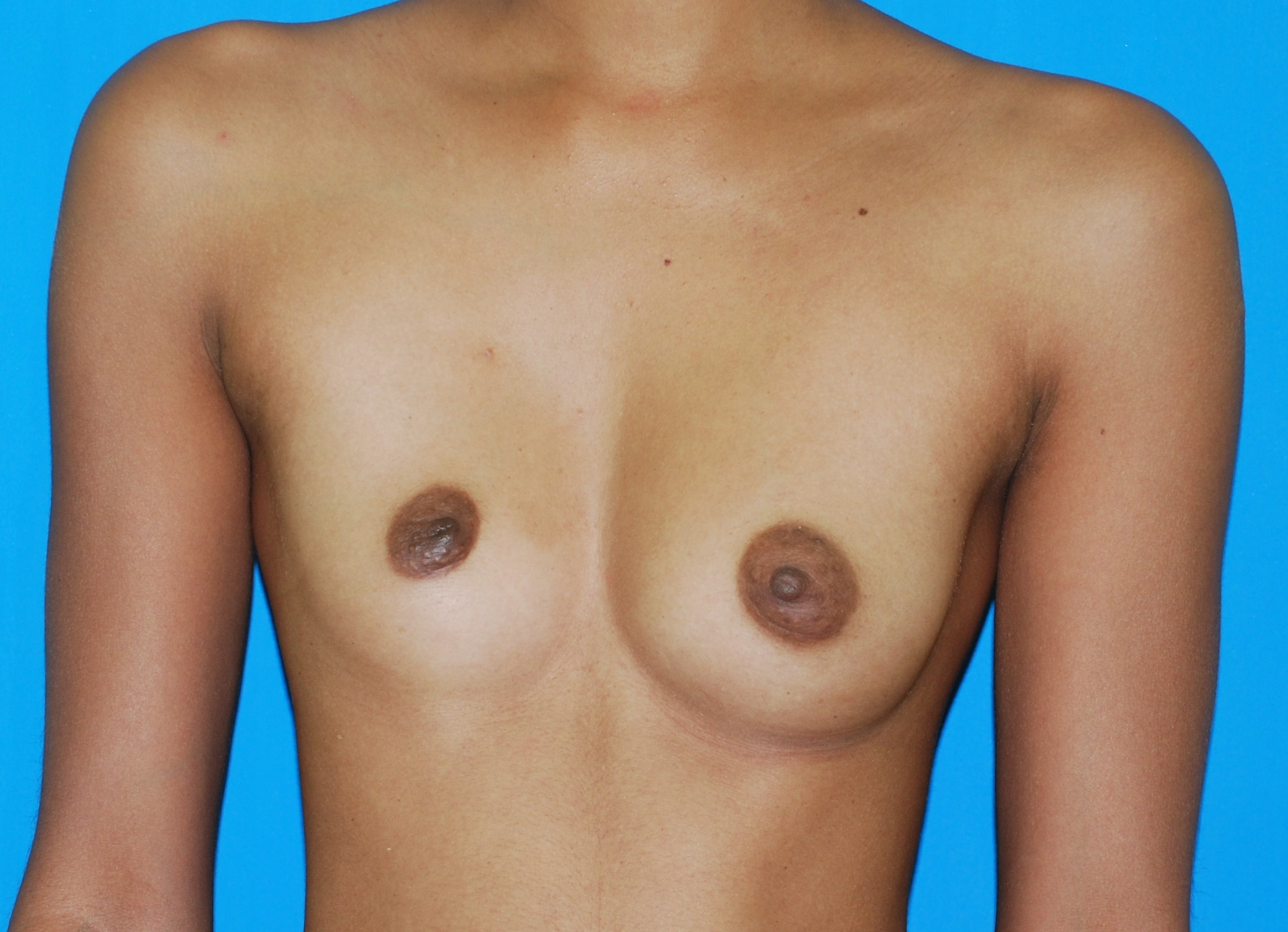 Augmentation before and after - before