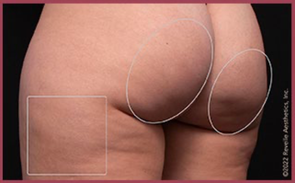 Avéli™ Long-Term Cellulite Reduction before and after - after