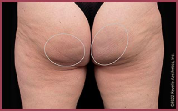 Avéli™ Long-Term Cellulite Reduction before and after - after
