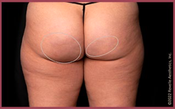 Avéli™ Long-Term Cellulite Reduction before and after - after