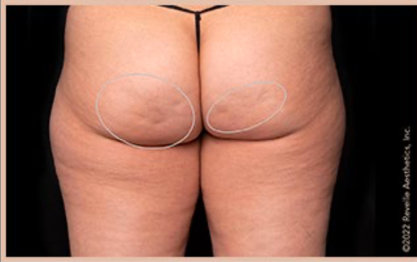 Avéli™ Long-Term Cellulite Reduction before and after - before