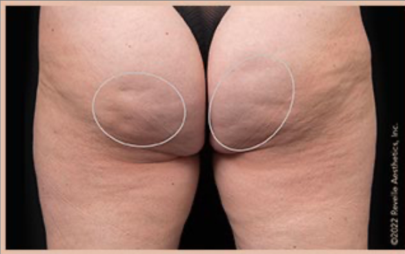 Avéli™ Long-Term Cellulite Reduction before and after - before