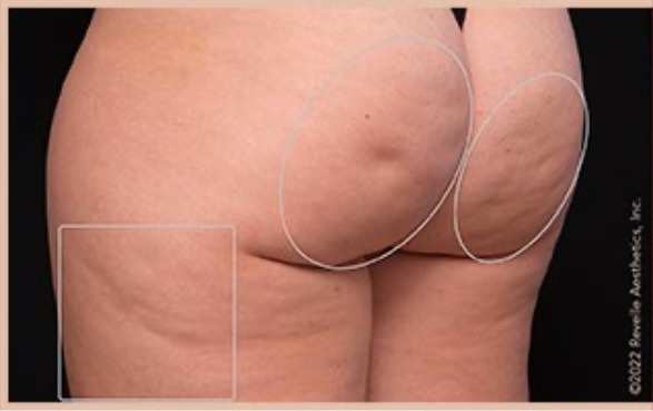 Avéli™ Long-Term Cellulite Reduction before and after - before