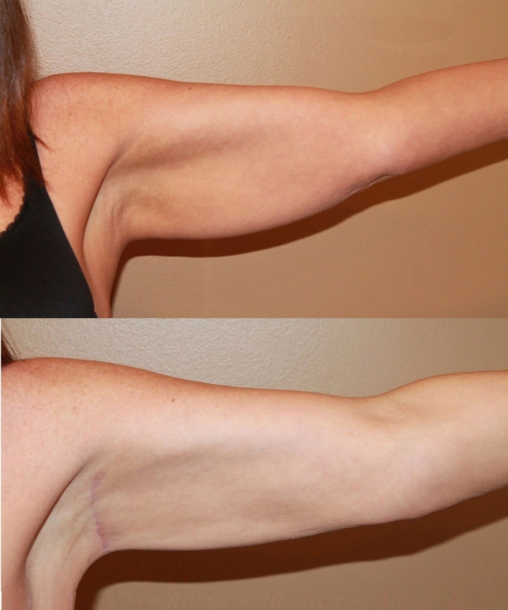Arm Lift before and after - after