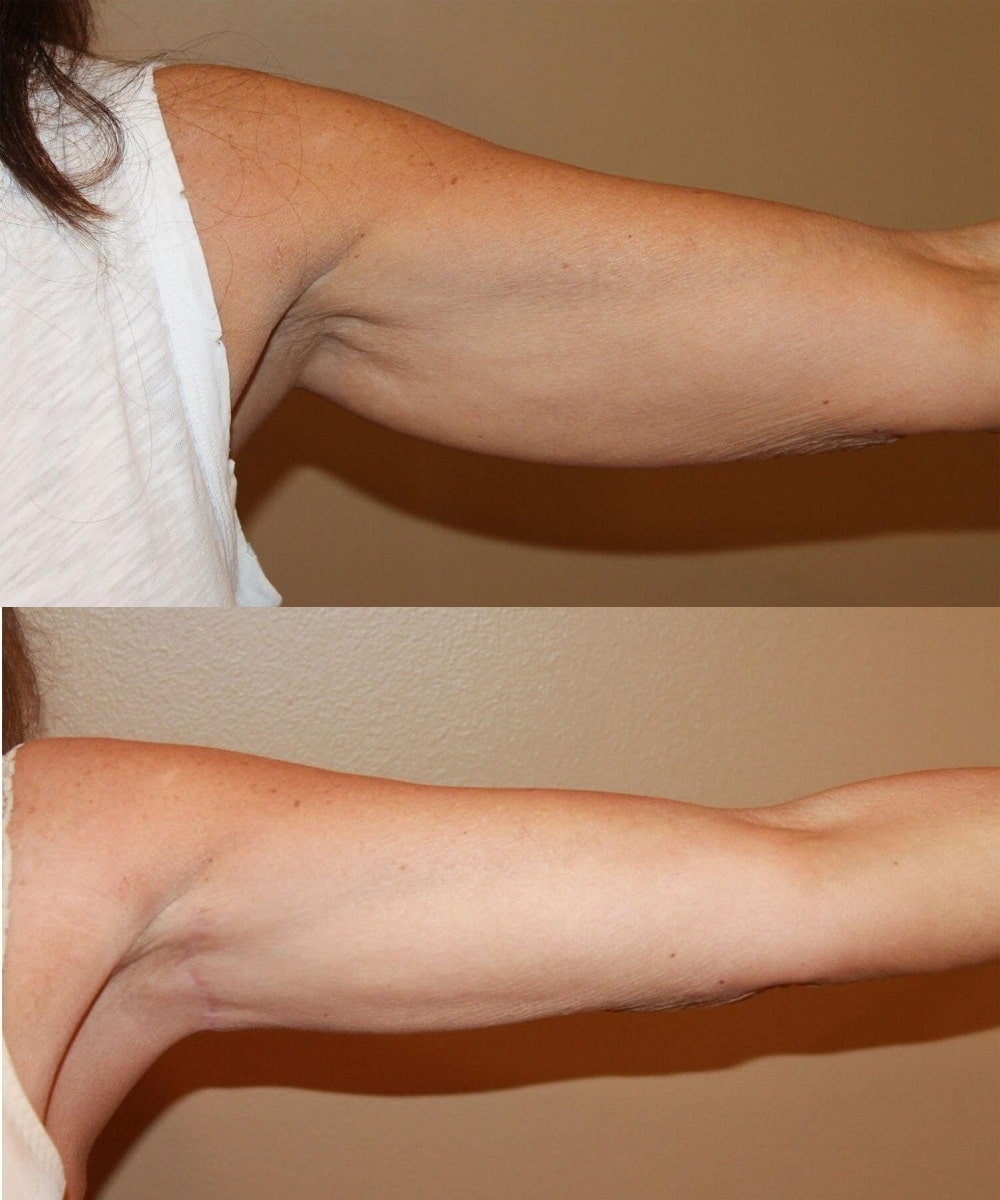 Arm Lift before and after - after