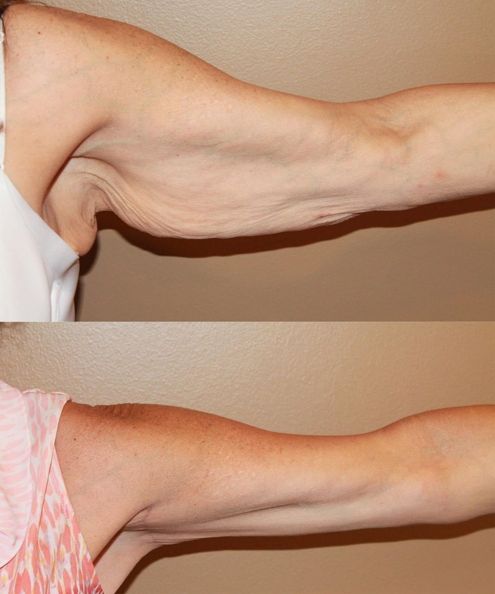 Arm Lift before and after - after
