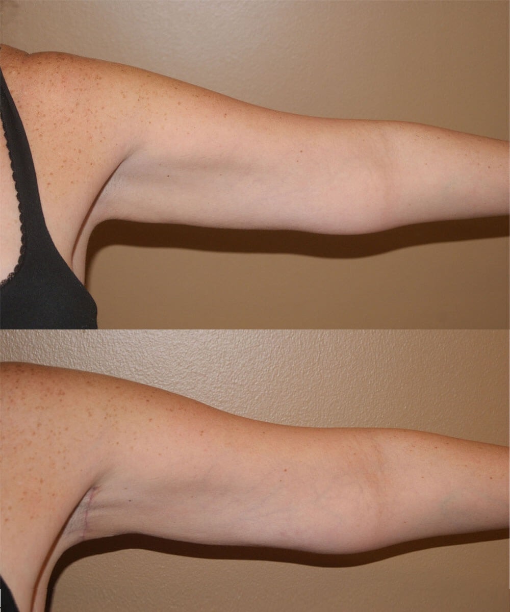 Arm Lift before and after - after