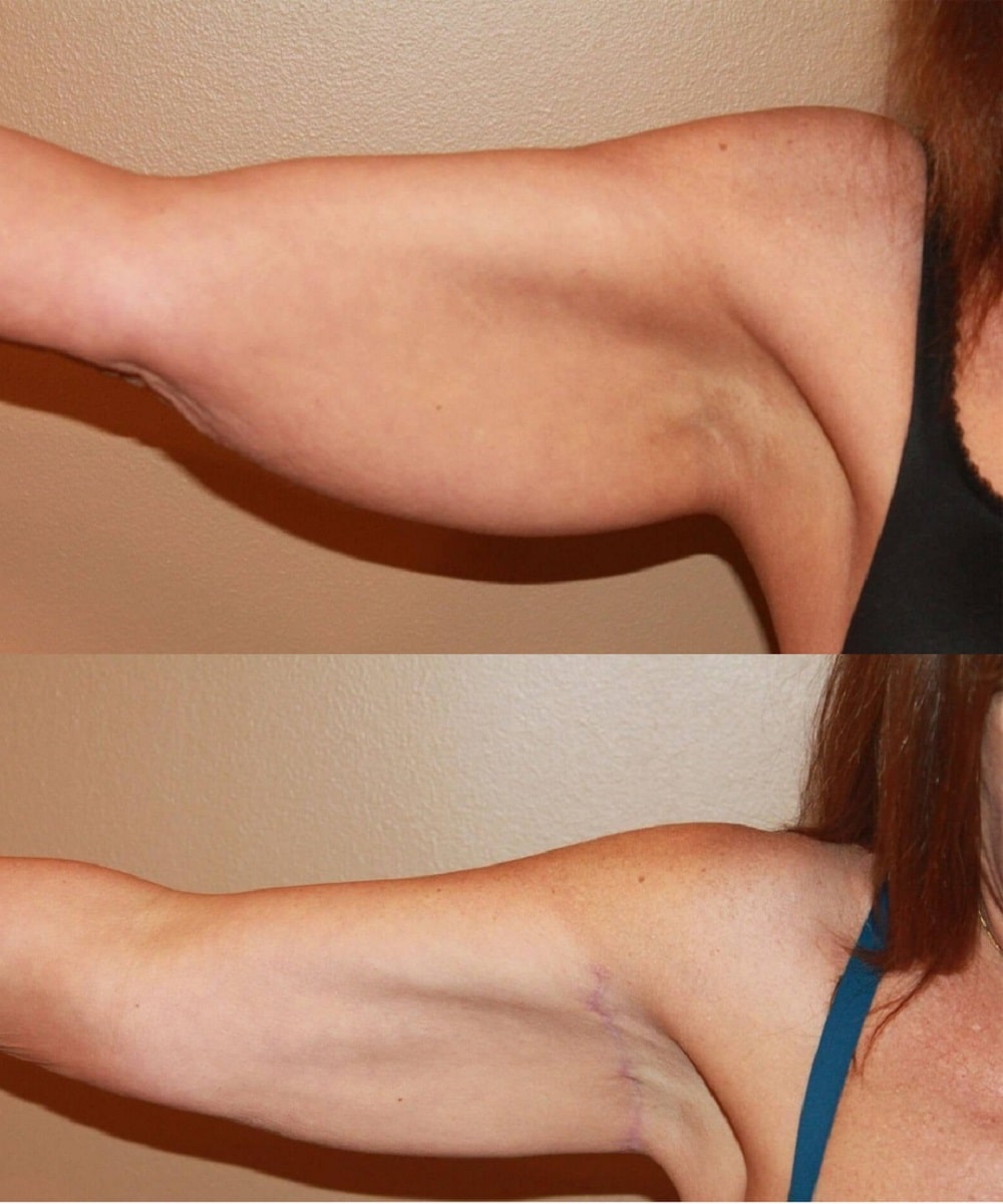 Arm Lift before and after - before