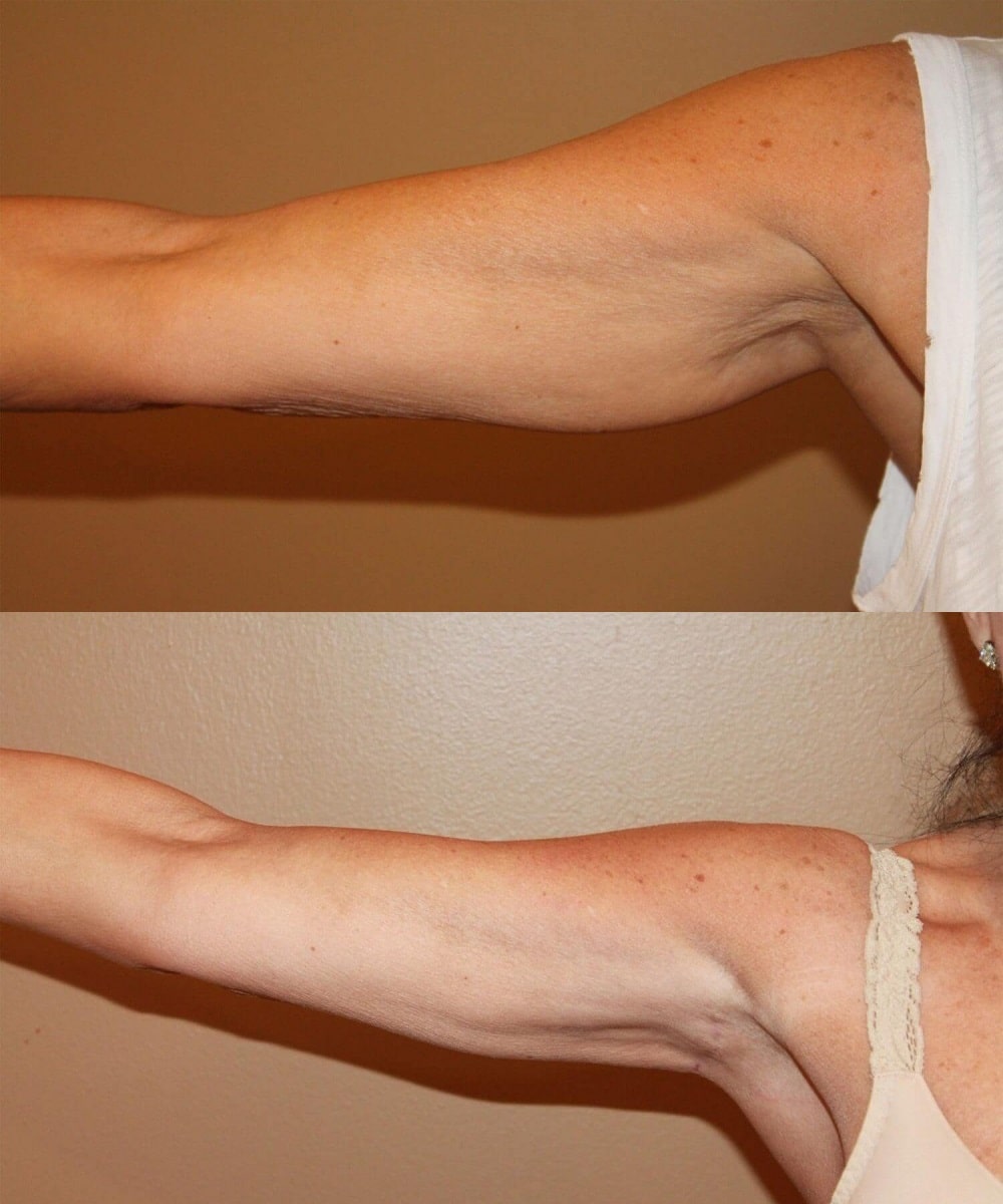 Arm Lift before and after - before