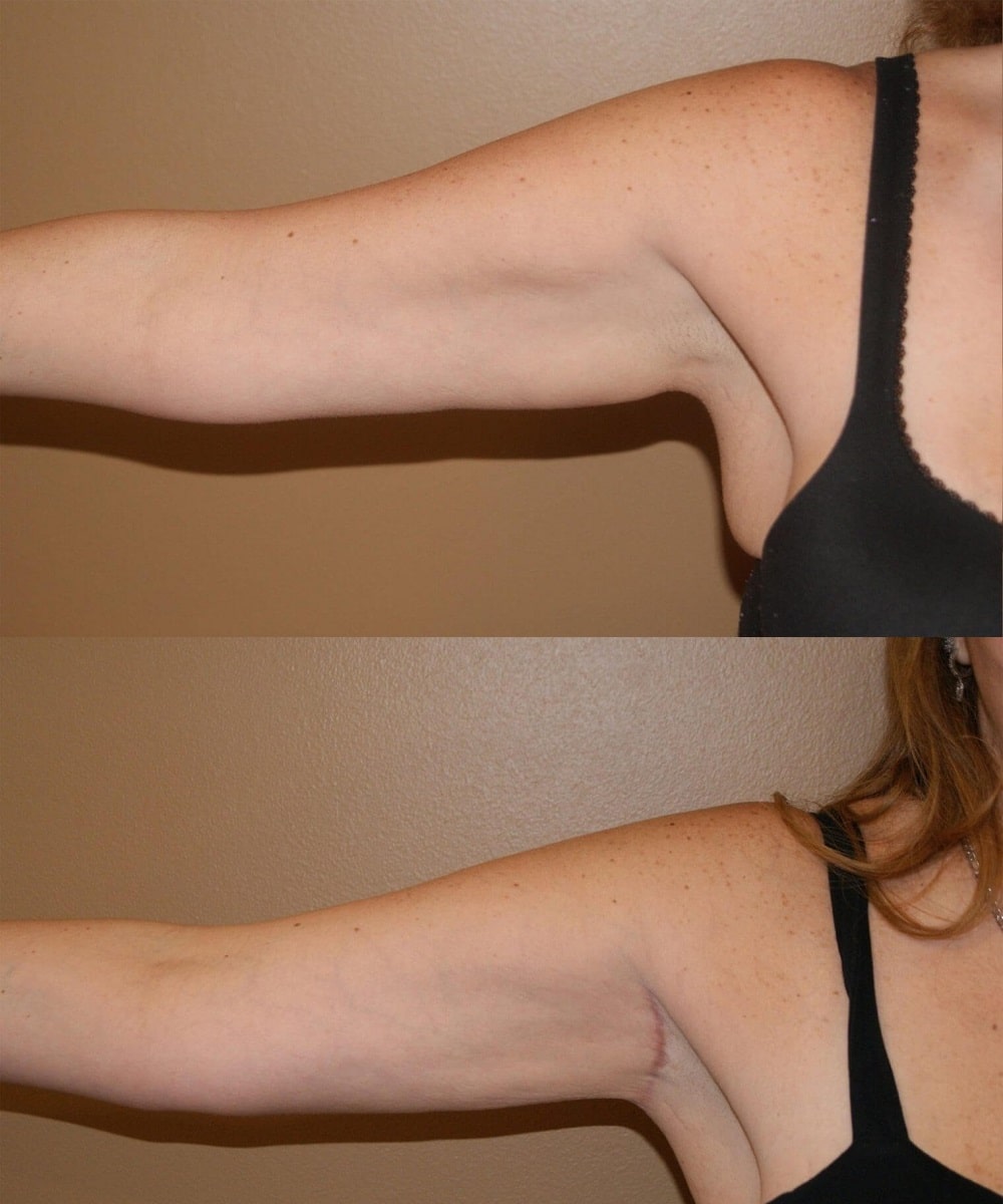 Arm Lift before and after - before