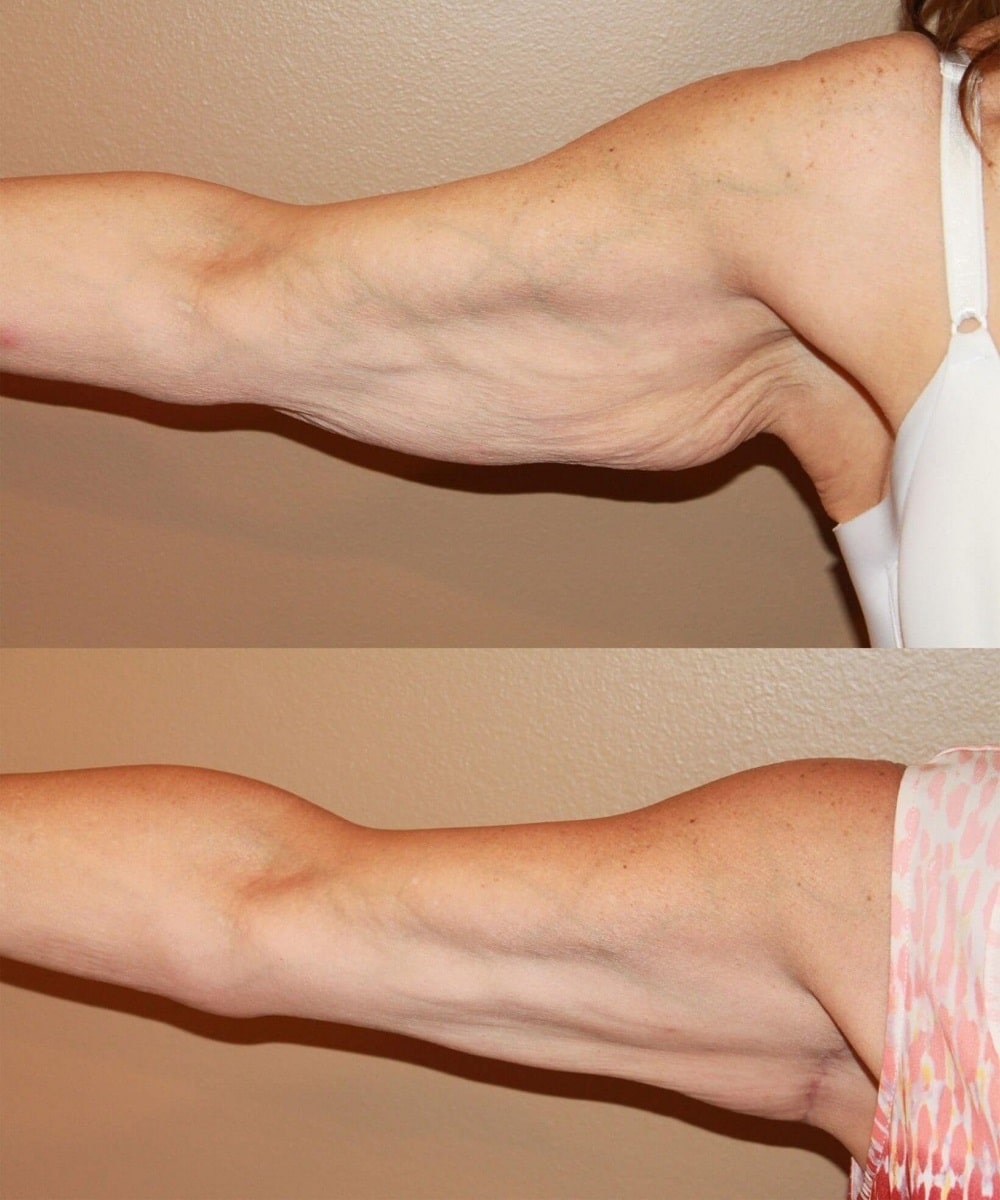 Arm Lift before and after - before