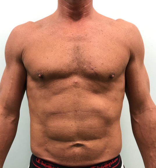 Vaser 4D LipoSculpt before and after - after