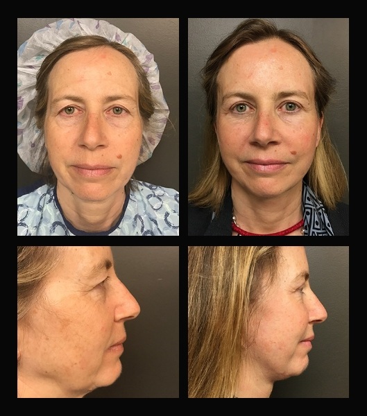 Blepharoplasty before and after - after
