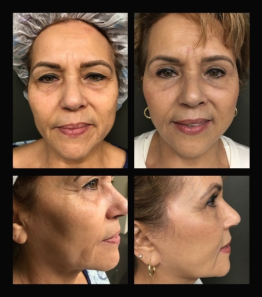 Blepharoplasty before and after - after
