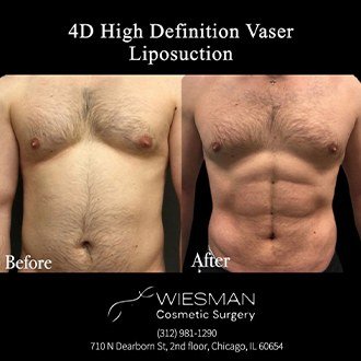 Liposuction before and after - before