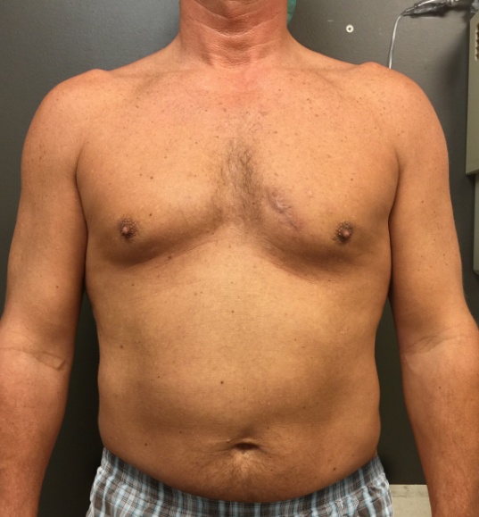 Vaser 4D LipoSculpt before and after - before