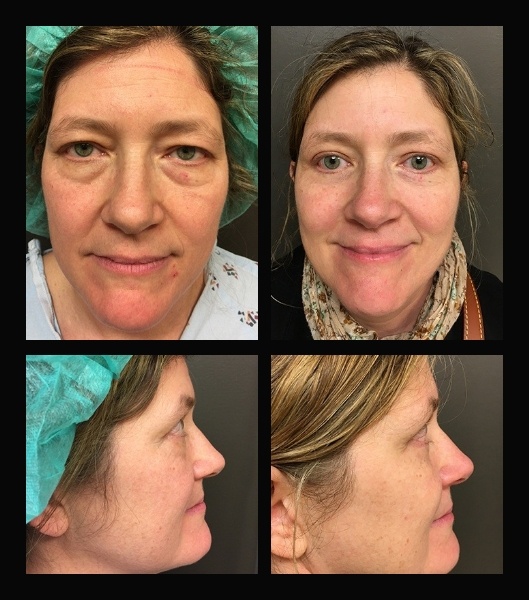 Blepharoplasty before and after - before