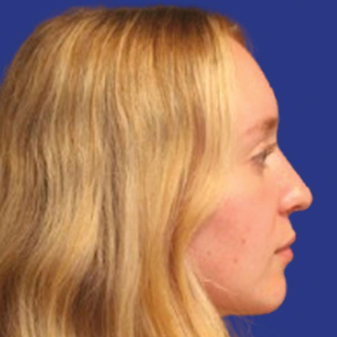 Procedure before and after - after