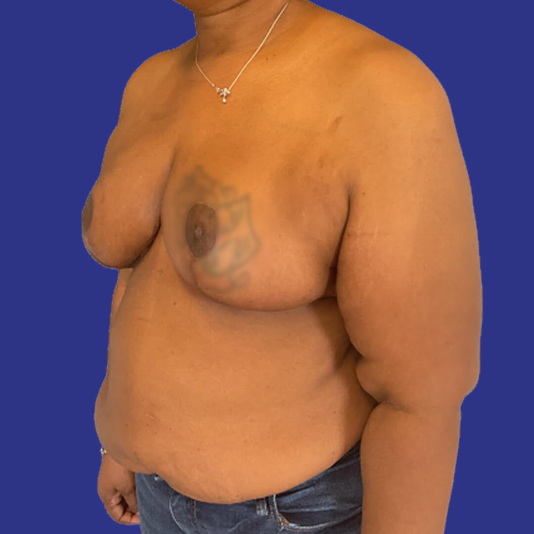 Procedure before and after - after