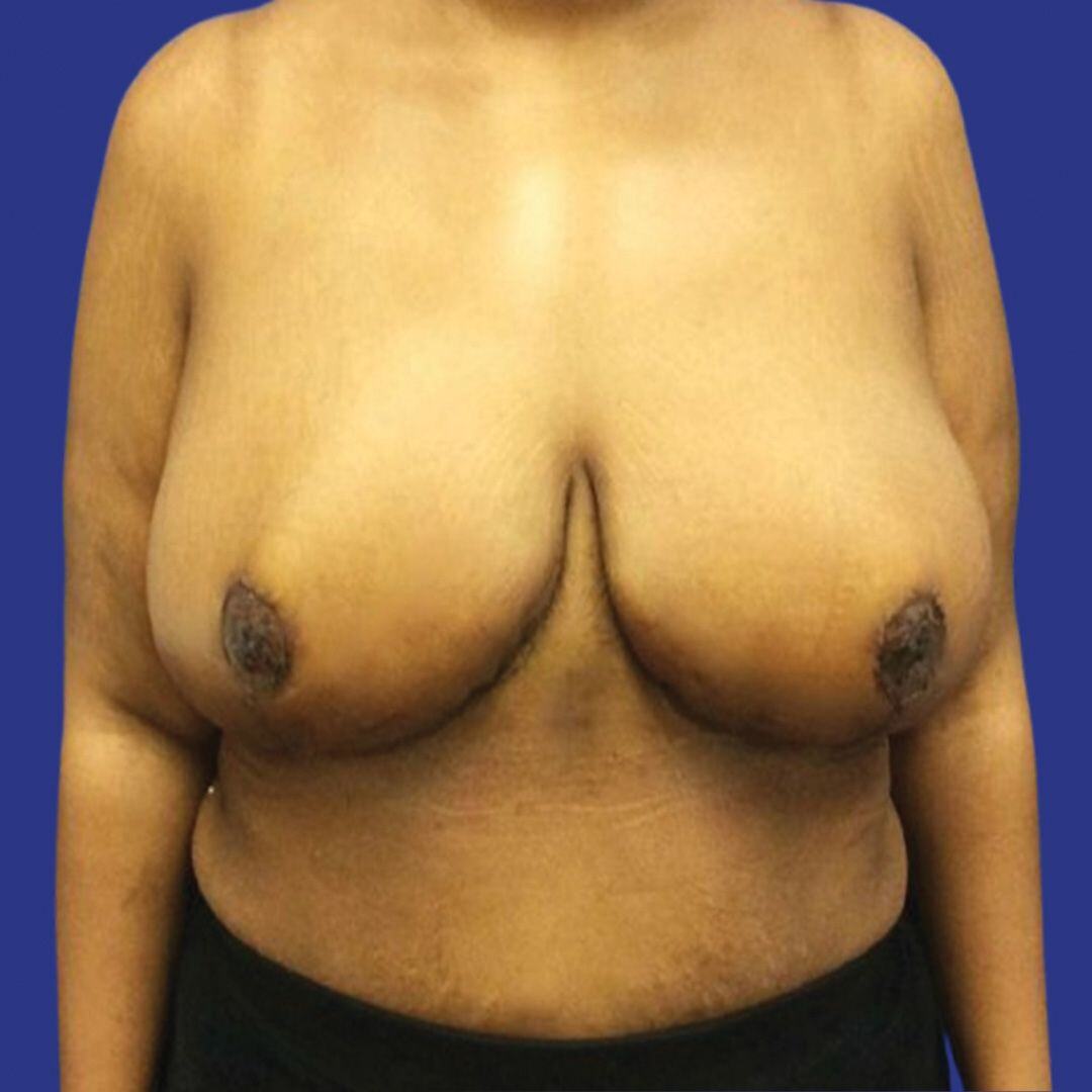 Procedure before and after - after