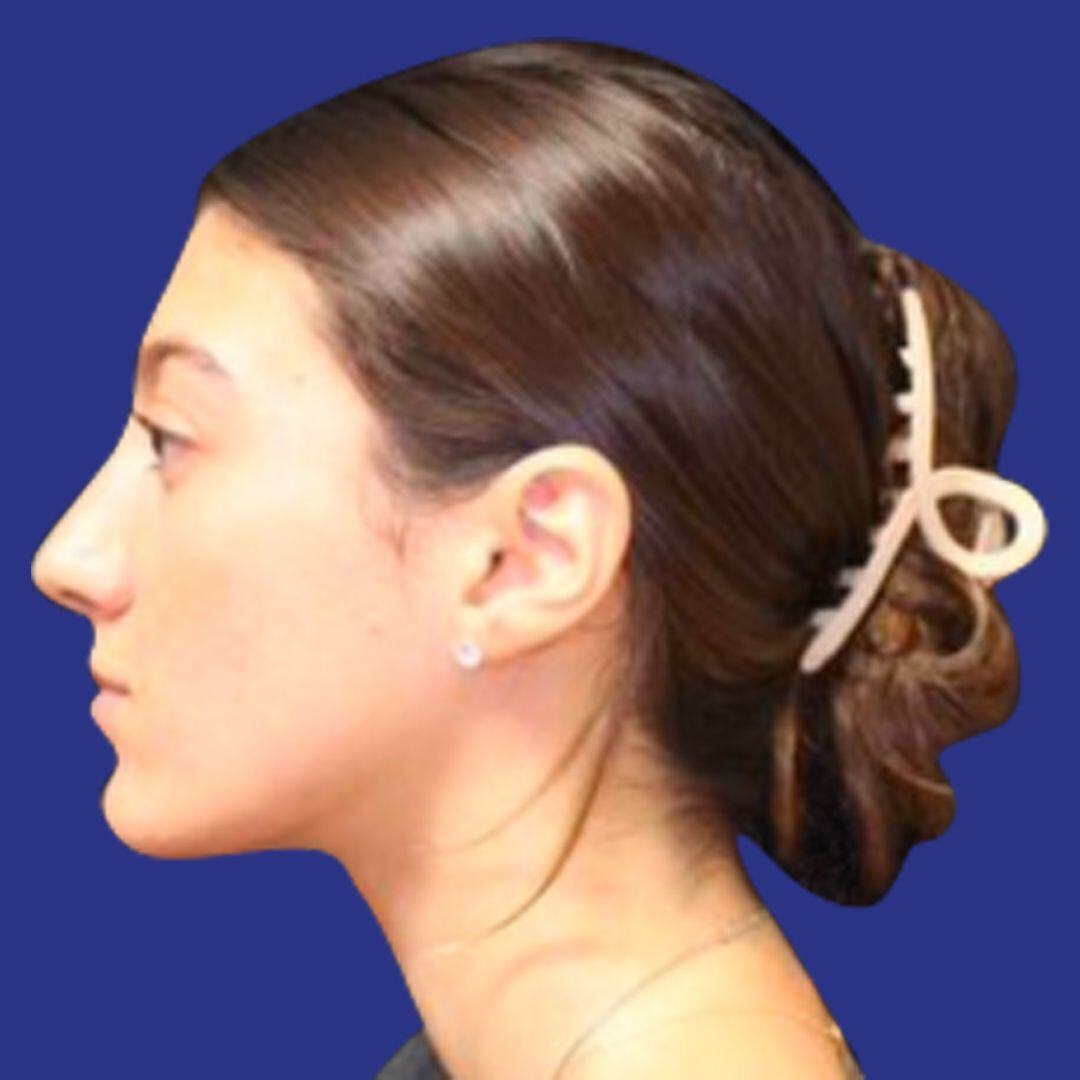 Procedure before and after - after