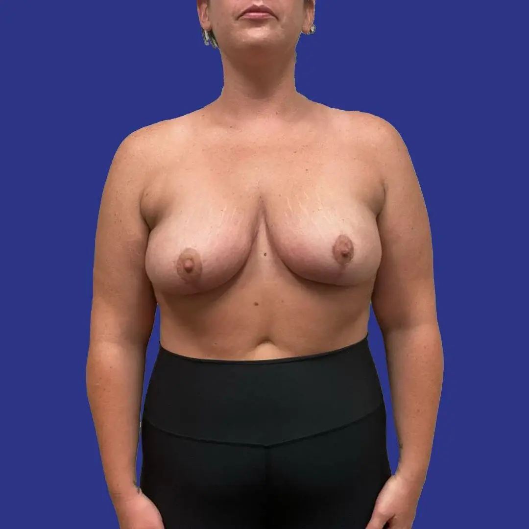 Procedure before and after - after
