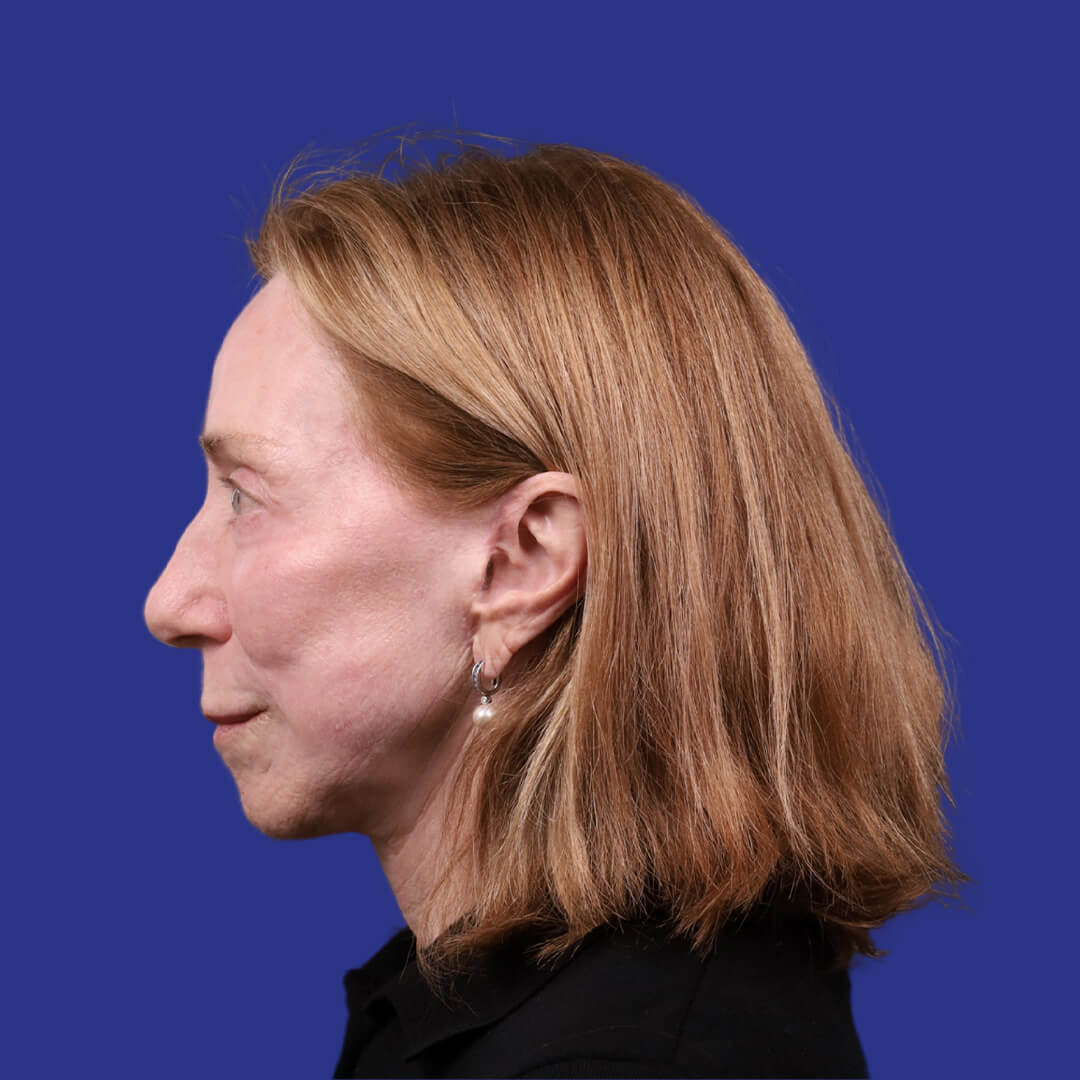 Procedure before and after - after