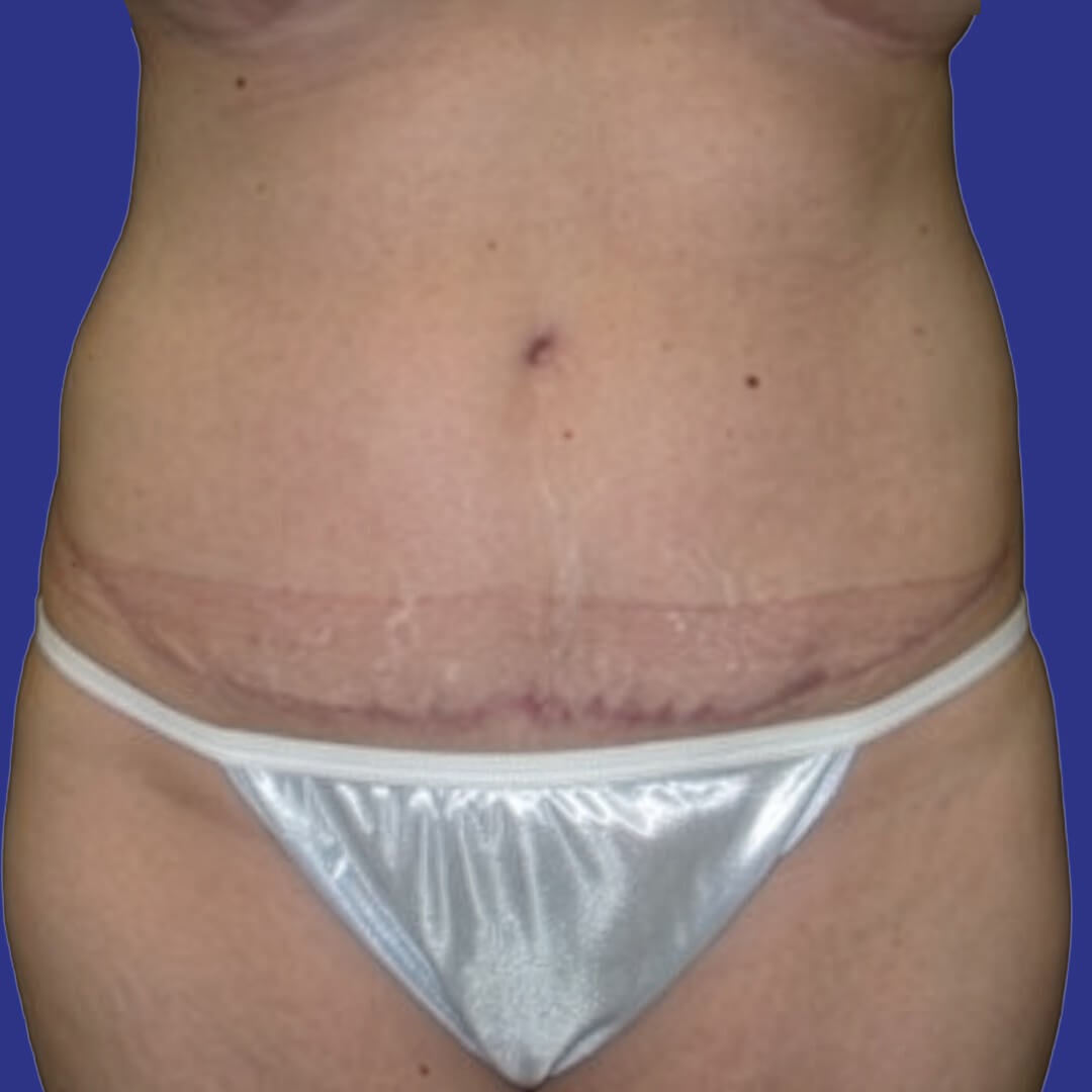 Procedure before and after - after