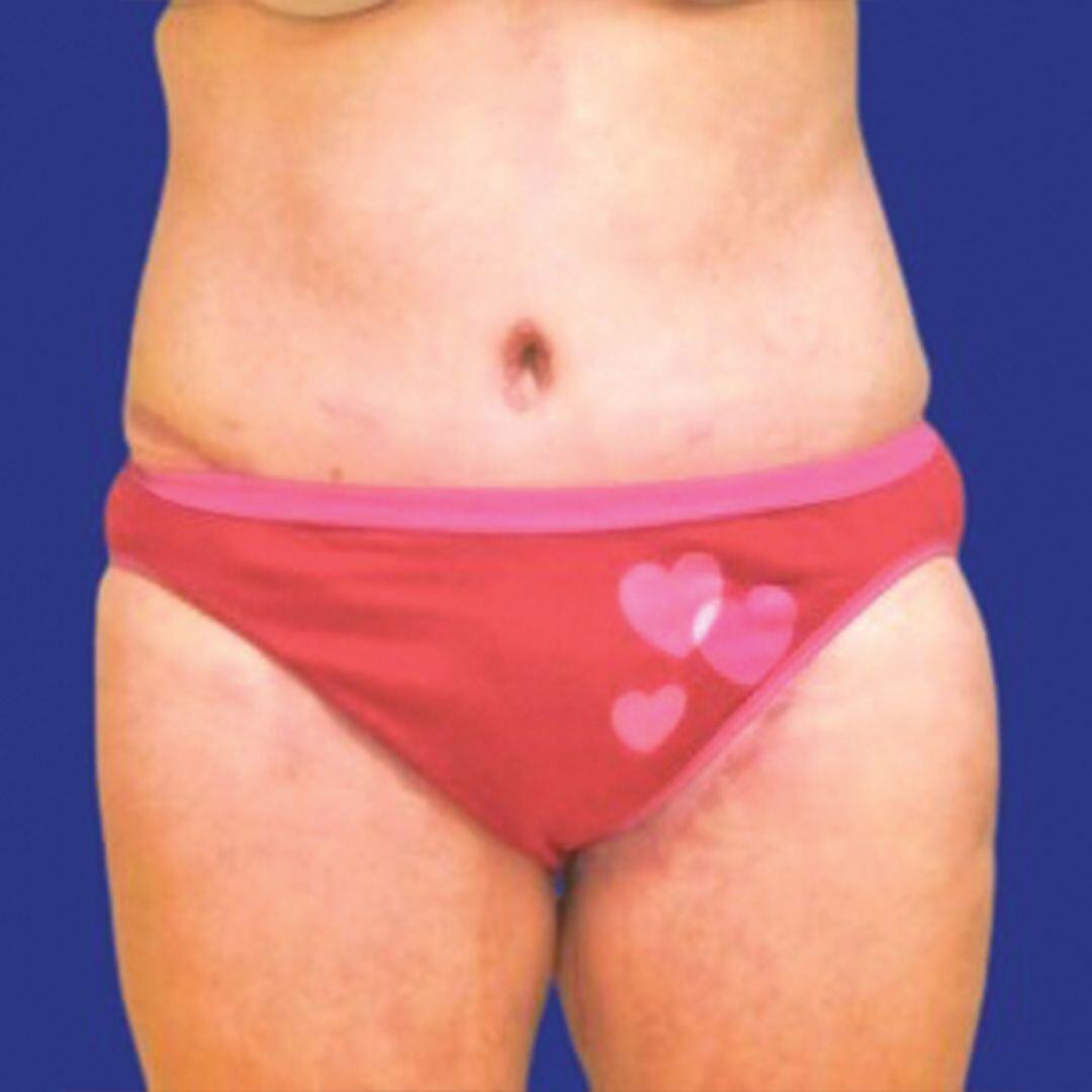 Procedure before and after - after