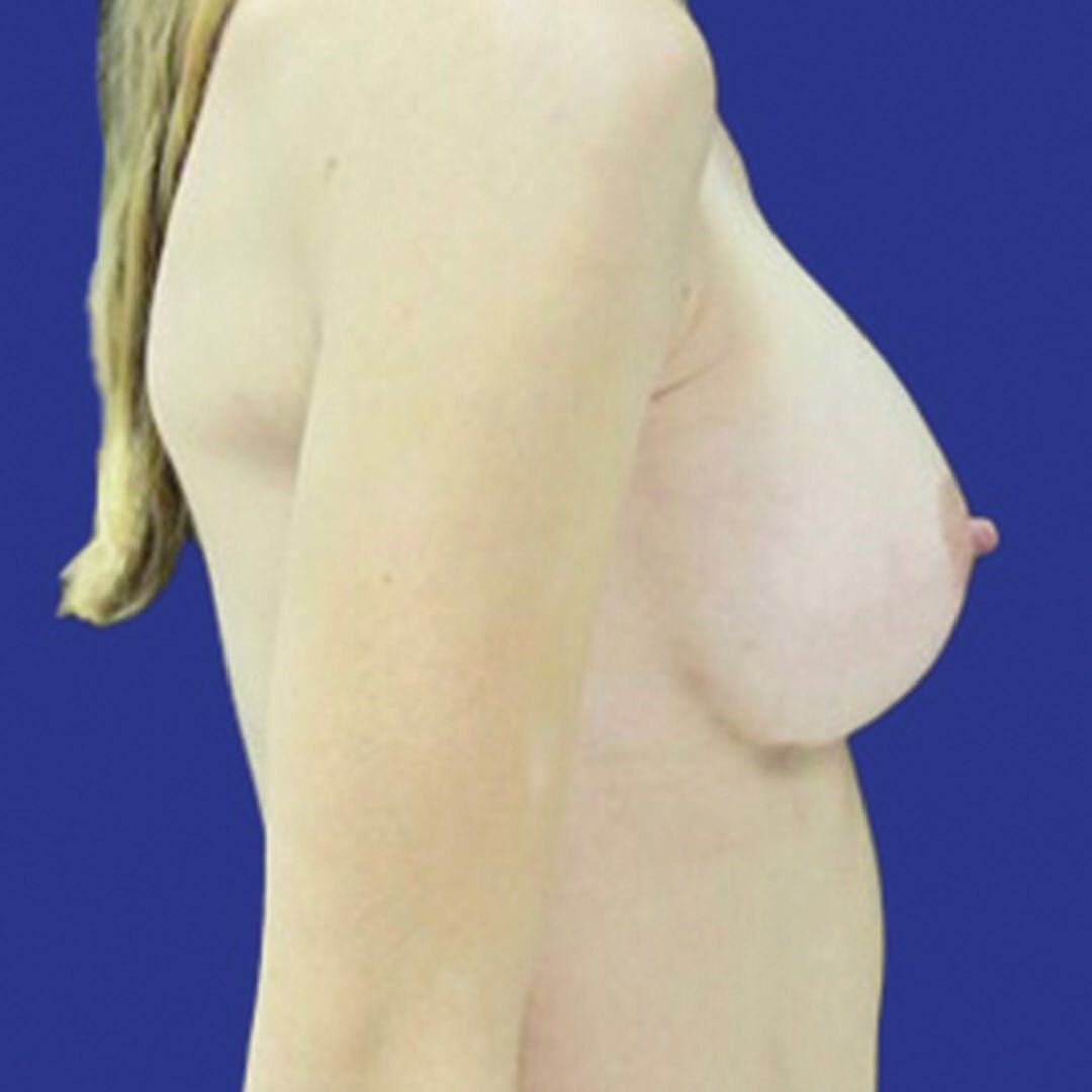 Procedure before and after - after