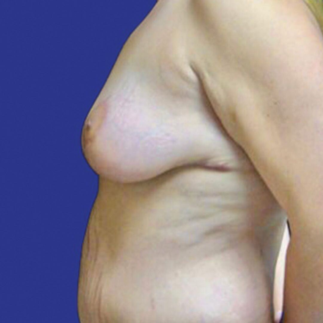 Procedure before and after - after