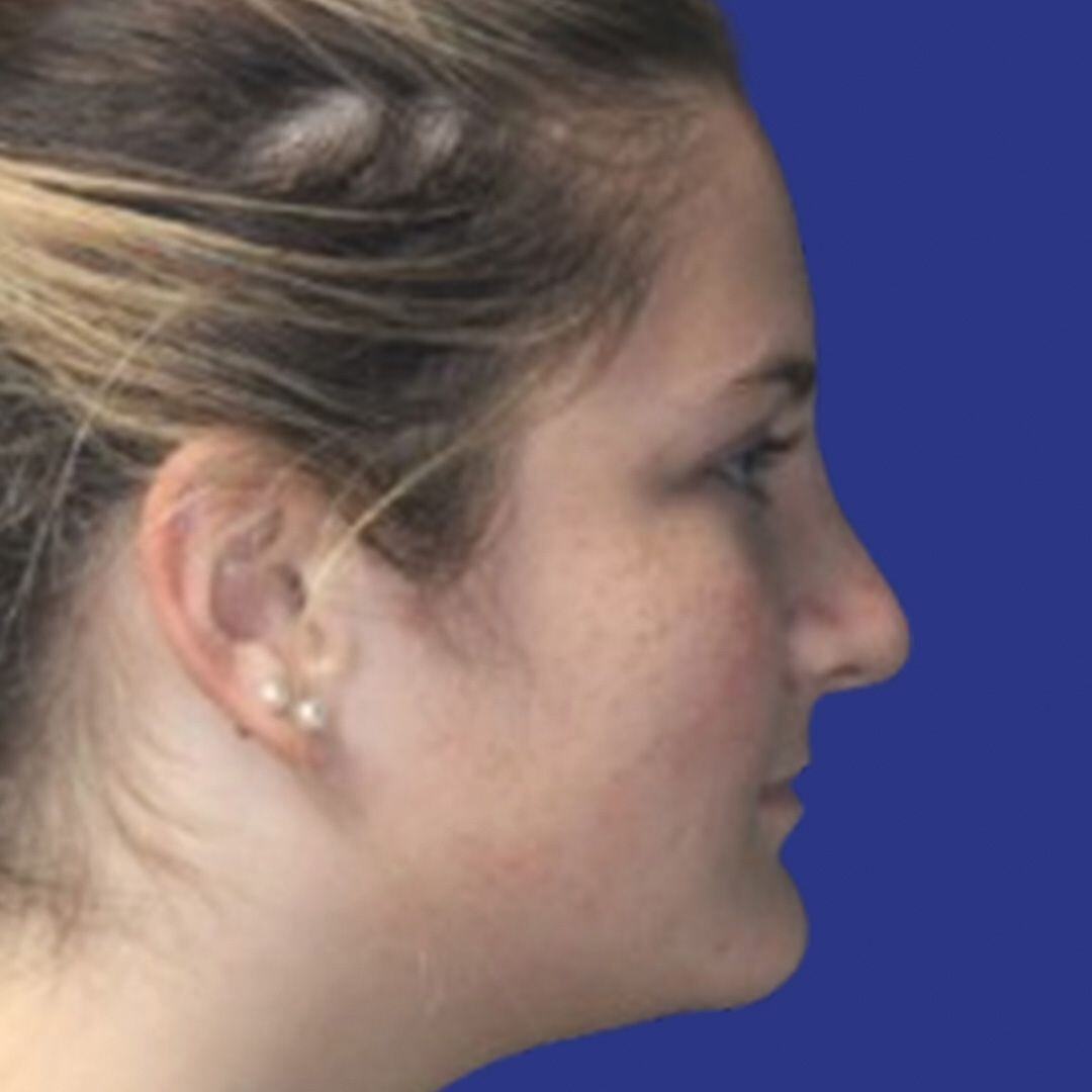 Procedure before and after - after