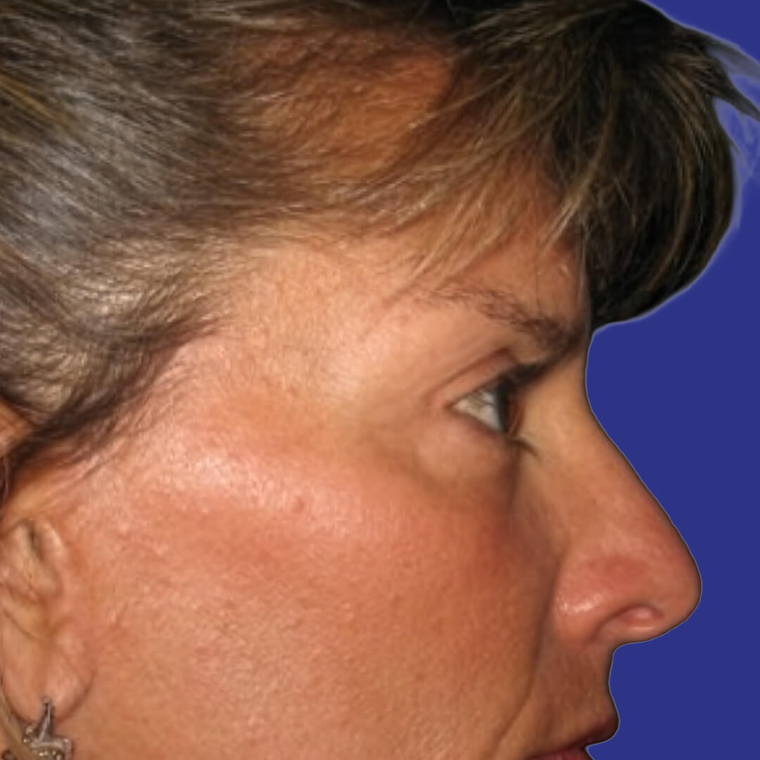 Procedure before and after - after