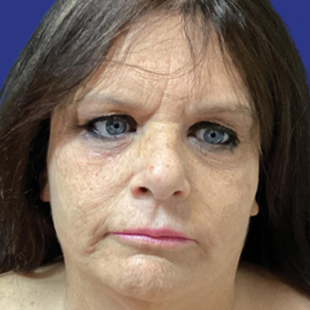 Procedure before and after - after