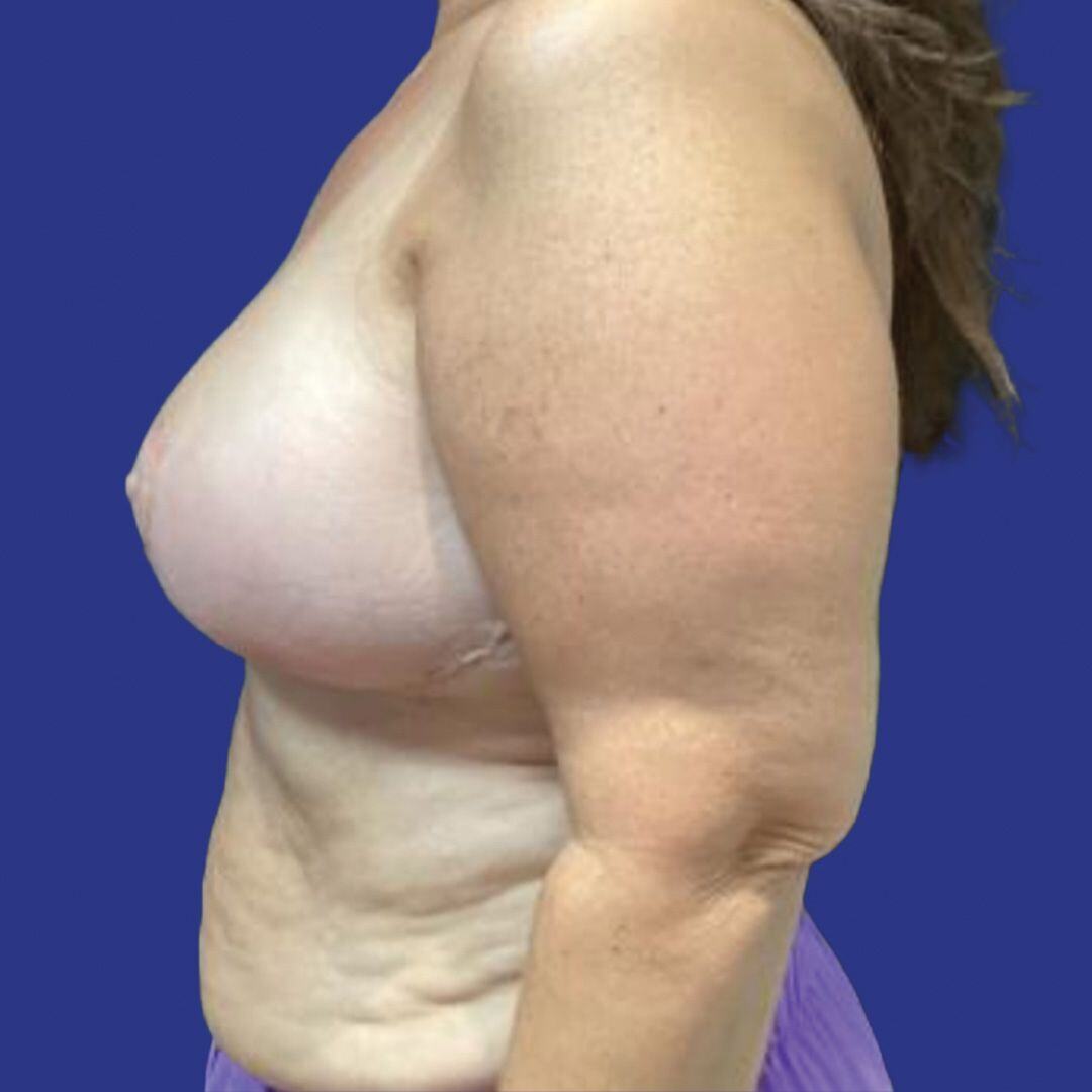 Procedure before and after - after