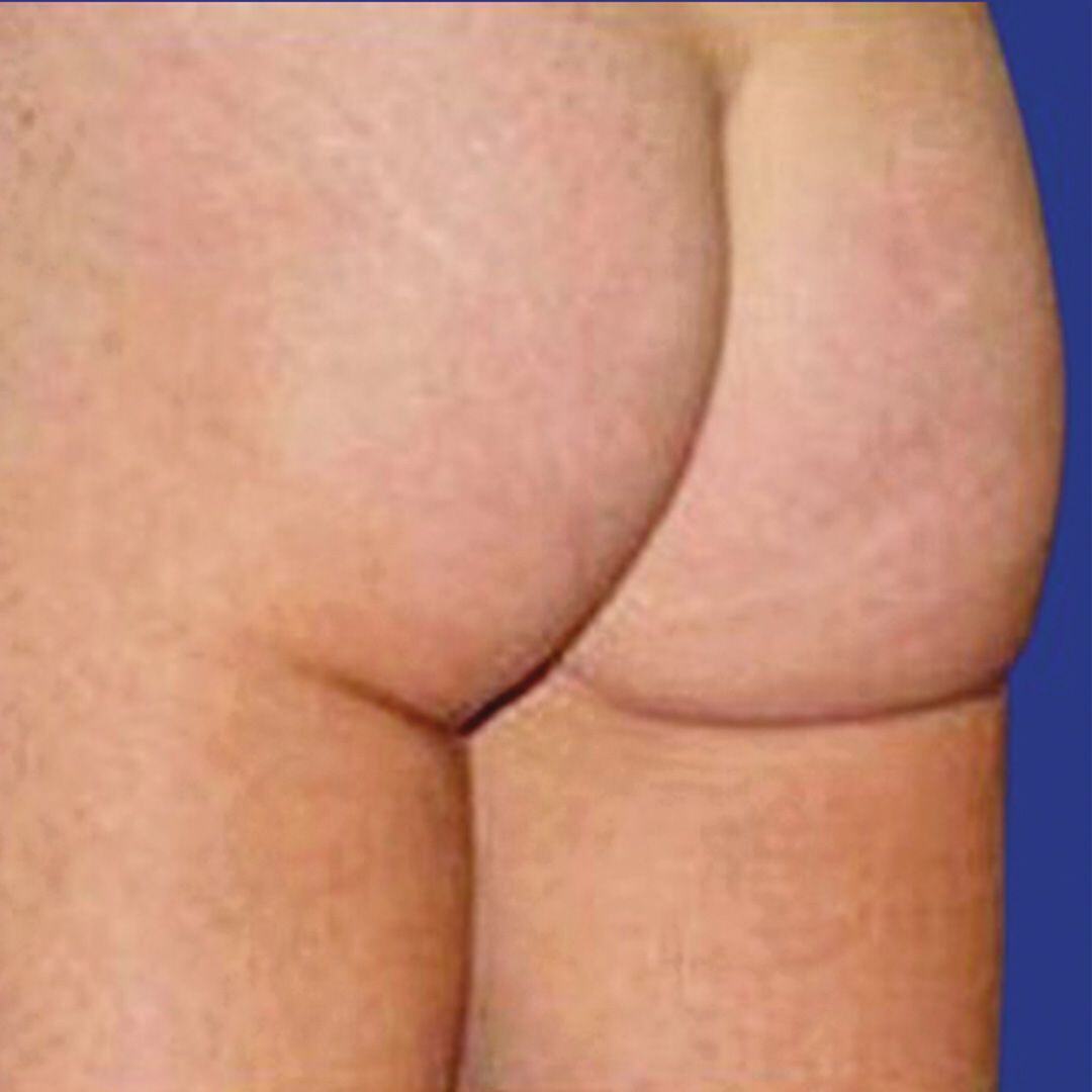 Procedure before and after - after