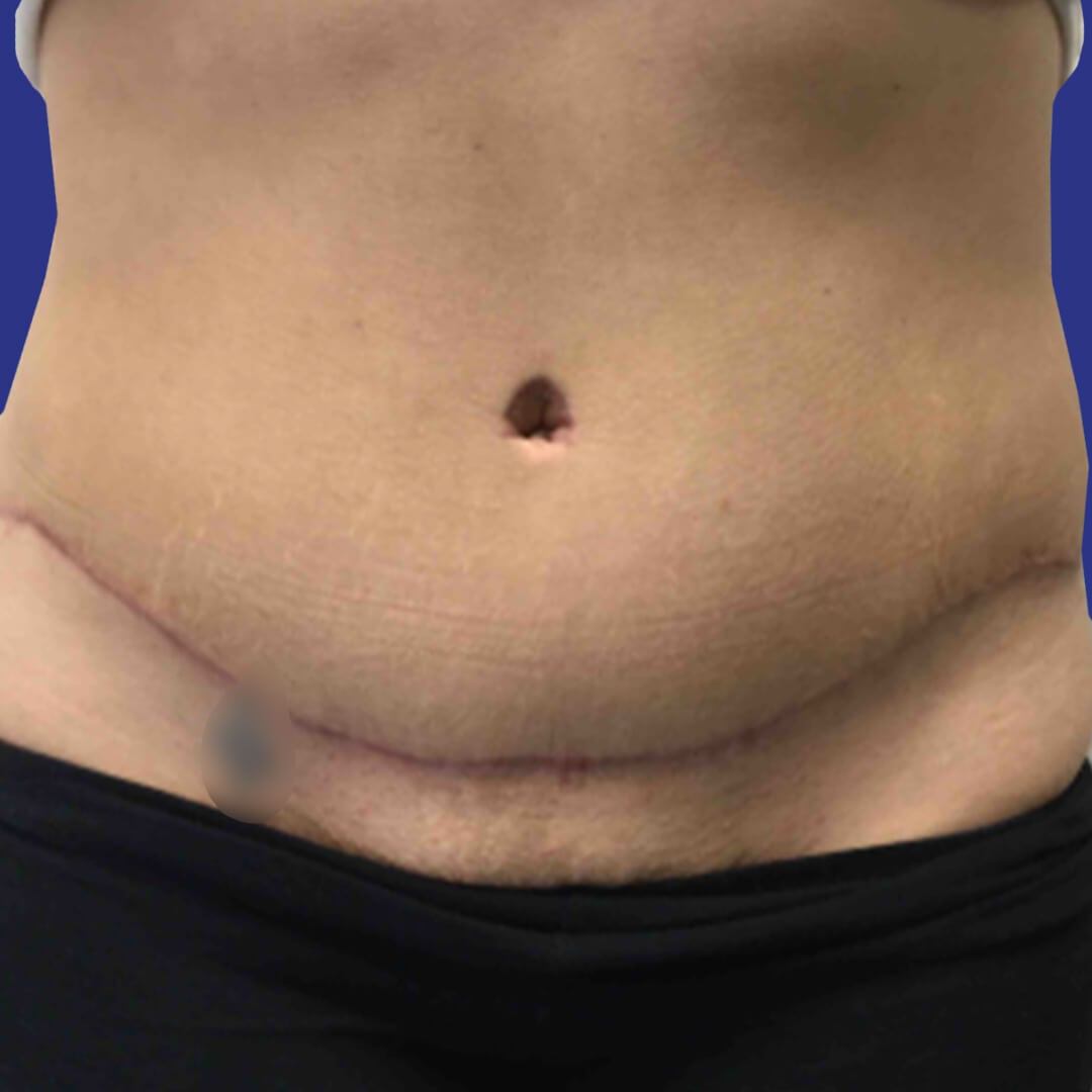 Procedure before and after - after
