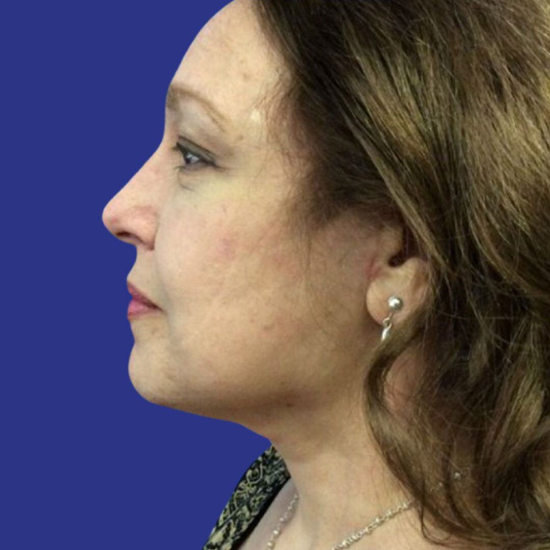 Procedure before and after - after