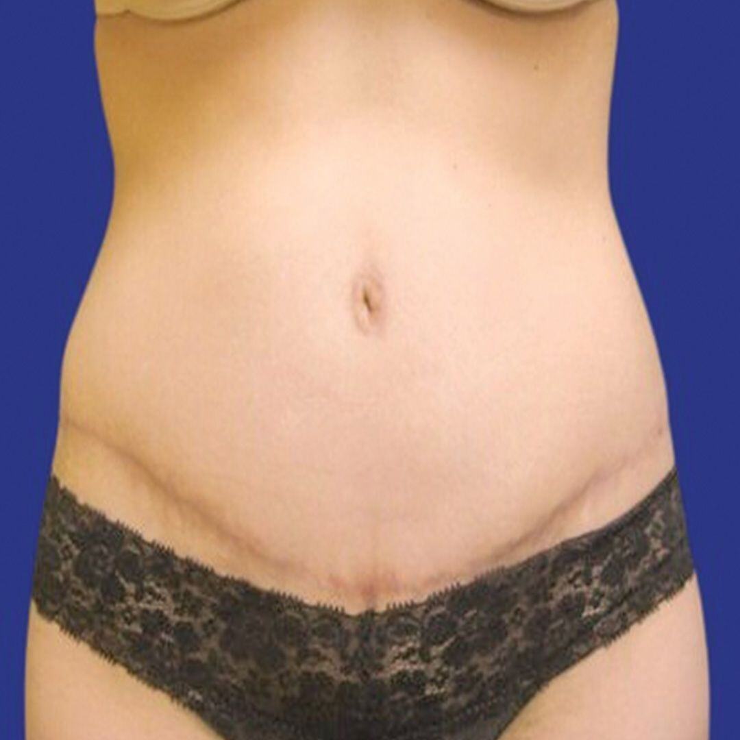 Procedure before and after - after