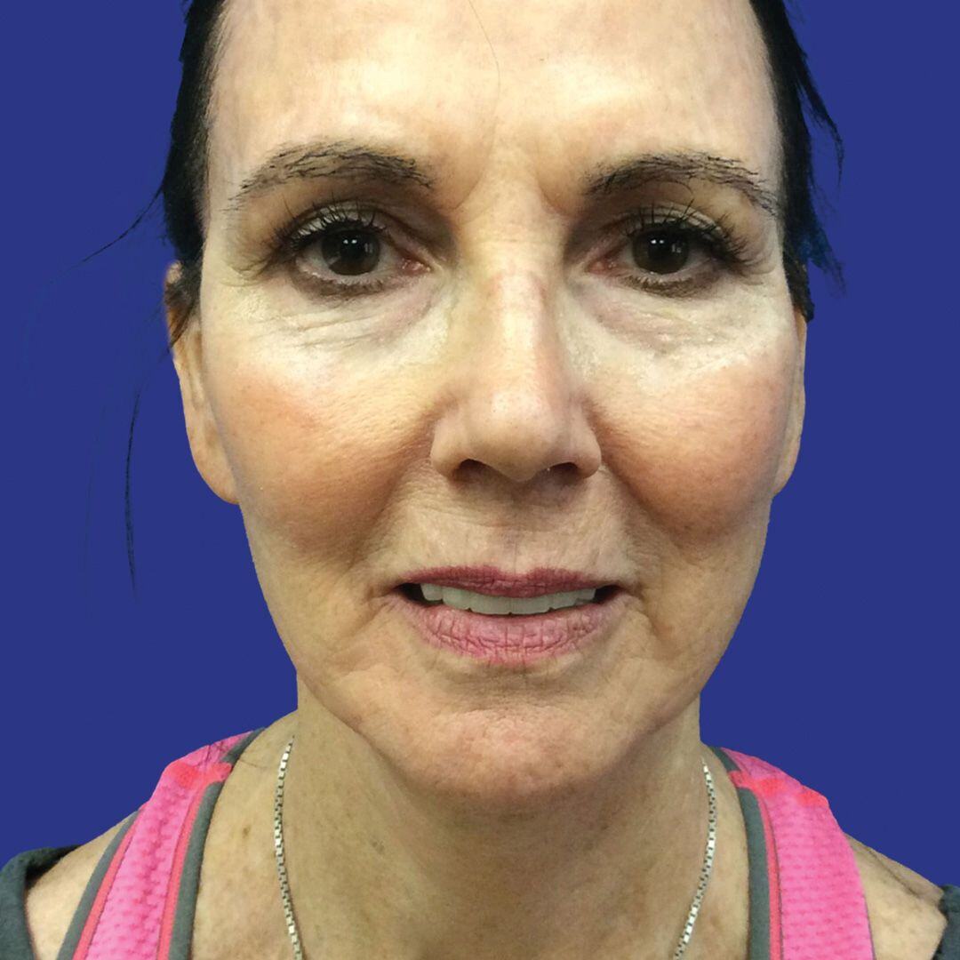 Procedure before and after - after